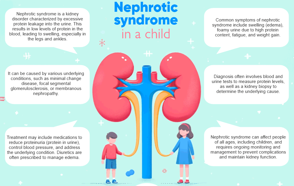 Nephrotic syndrome is a child

